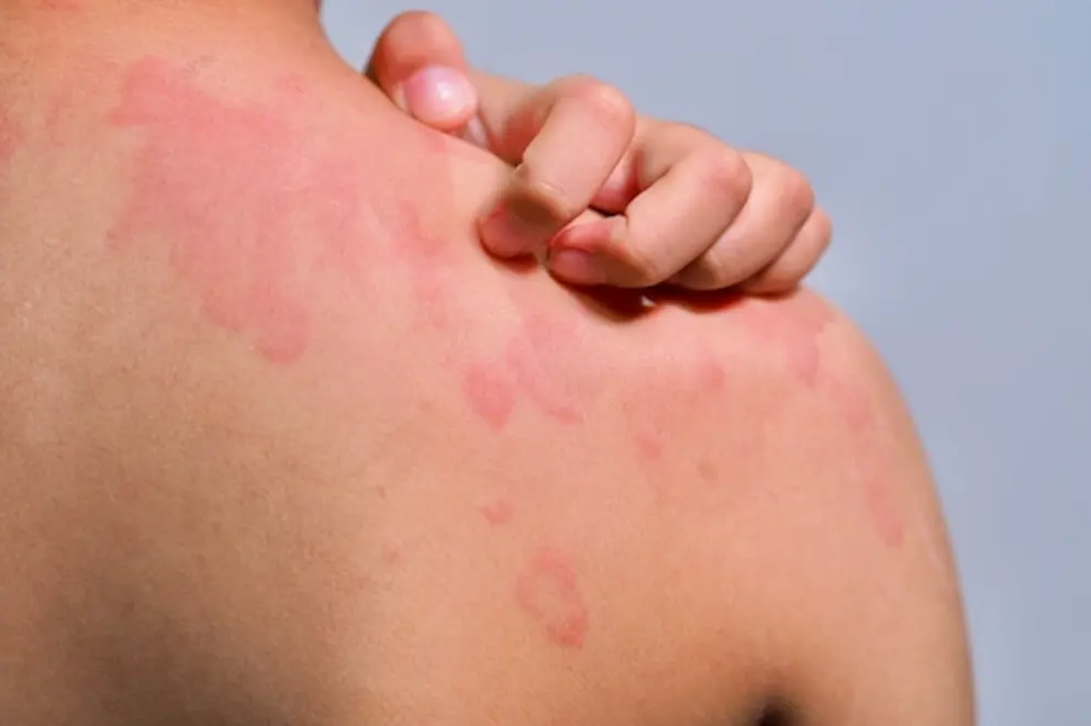 Close up photograph of shoulder skin with hives.