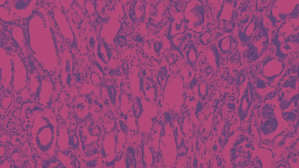 amyloidosis under microscope, pink and purple colours