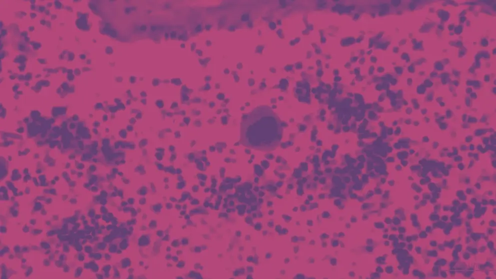 Megakaryocyte is a bone marrow cell responsible for the production of blood platelets, cellular image, pink and purple