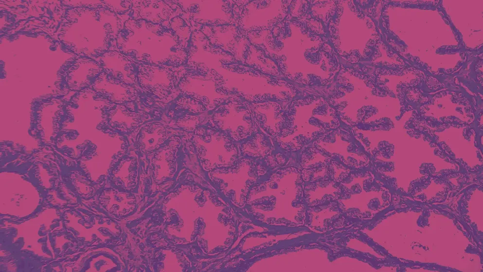 Prostate Cancer micrograph, pink and purple