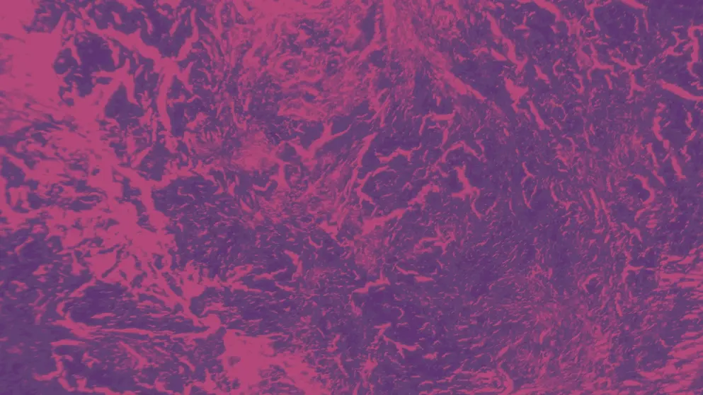 Lung with fibrosis, cell image, pink and purple colours