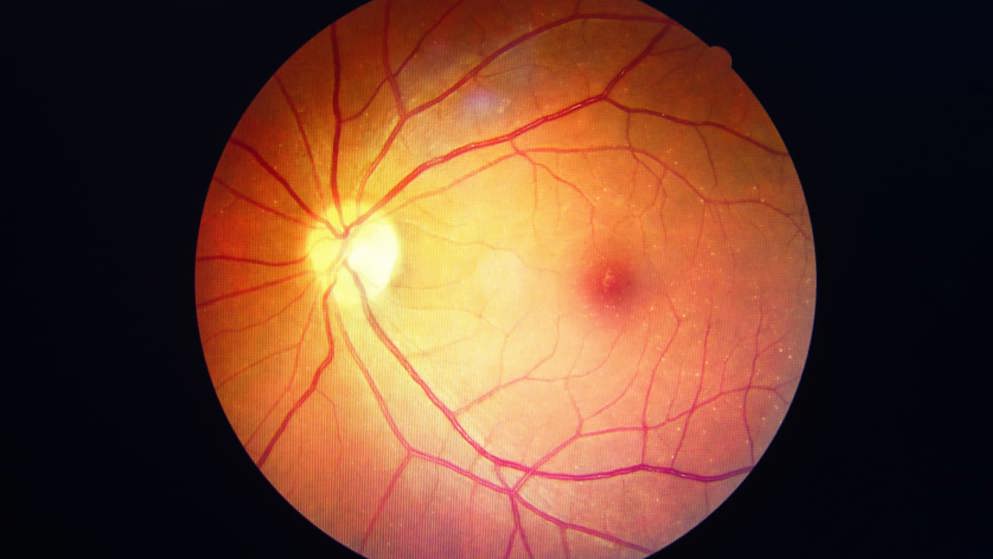 diabetes retinopathy