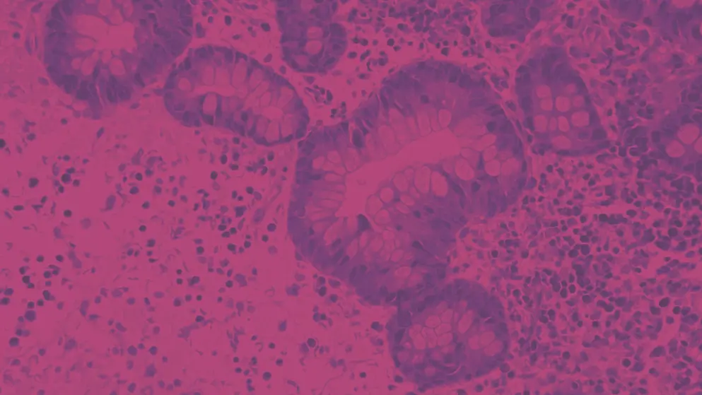 microscopic of ductal cell carcinoma from human breast cancer tissue, cell image, pink and purple