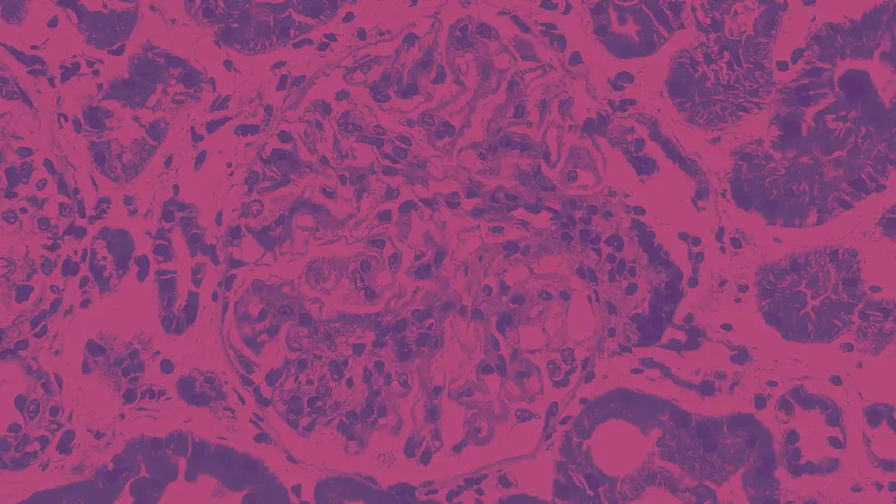 lupus nephritis, showing endocapillary hypercellularity under microscope