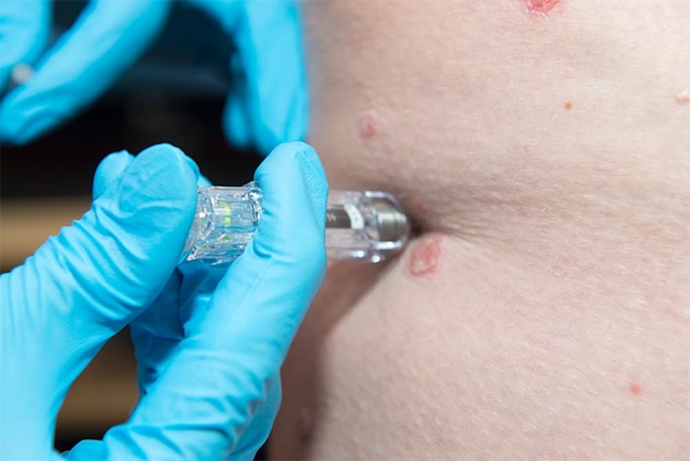 Biologic treatment for psoriasis