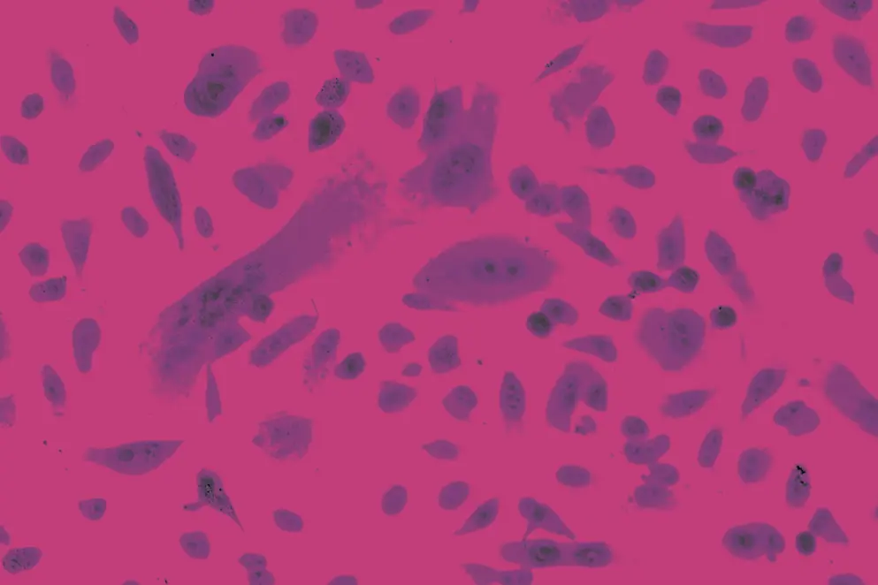 Photo of Prostate cancer cells under microscope, pink and purple tones.