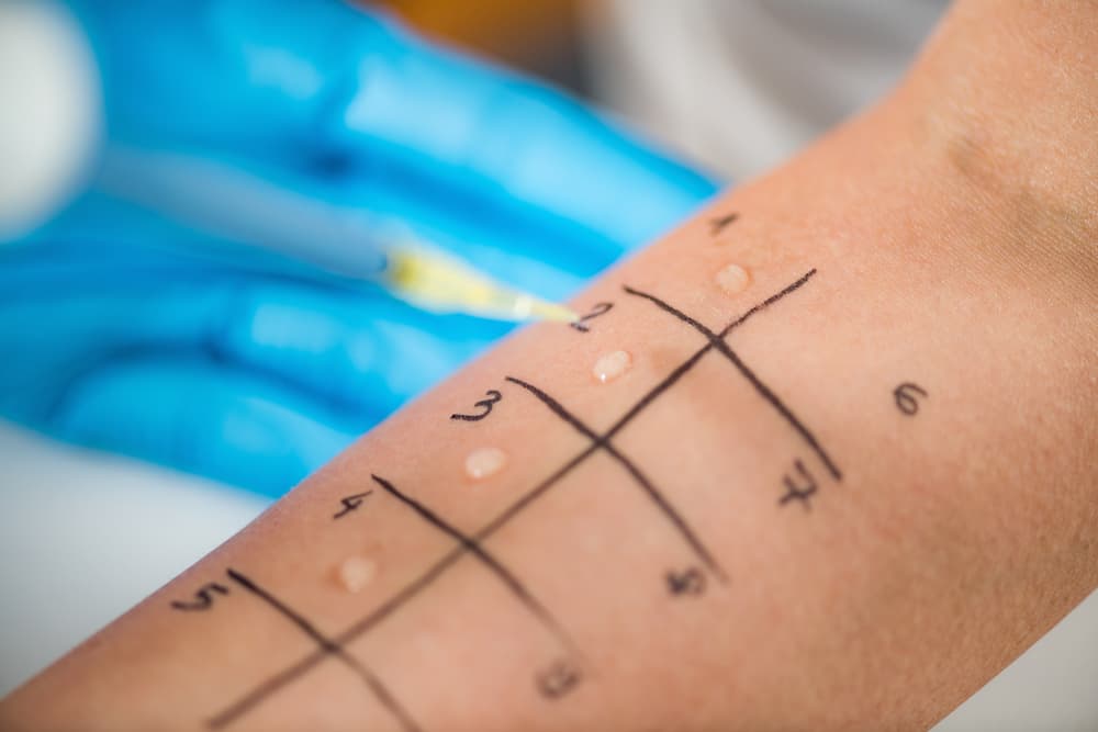 FoodAllergy_Allergen Skin Prick Test