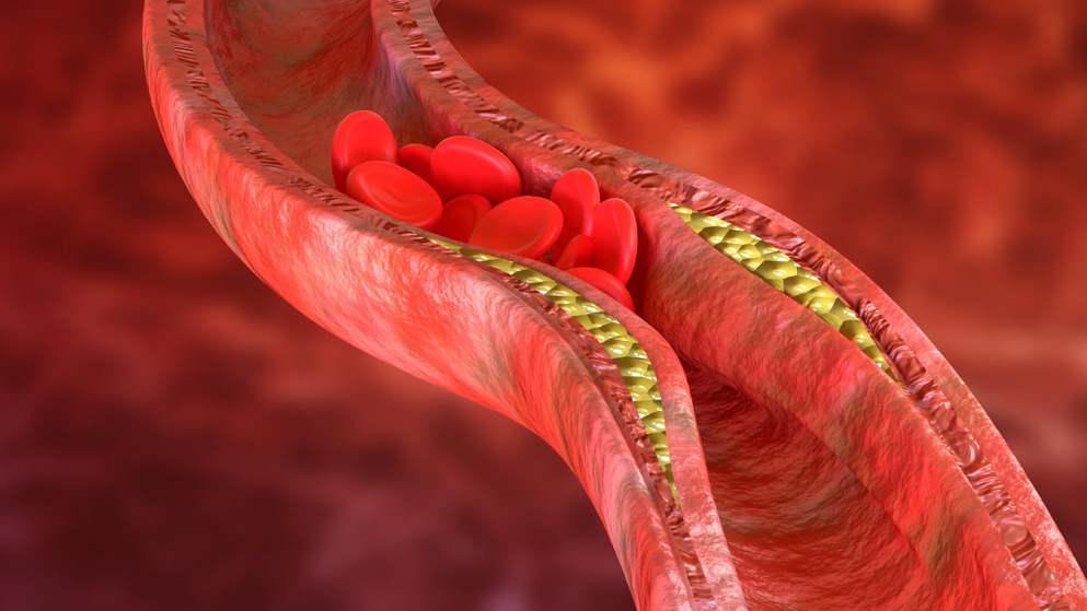 Lipids in ASCVD