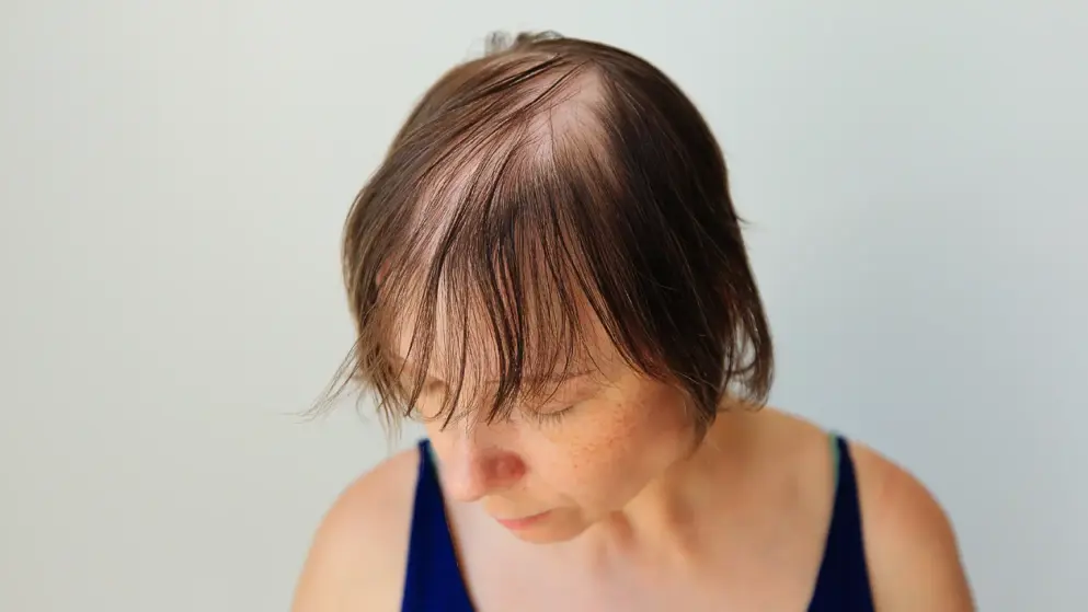 Alopecia areata, female patient