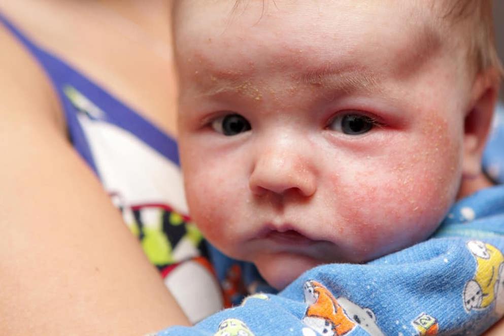 Atopic Dermatitis