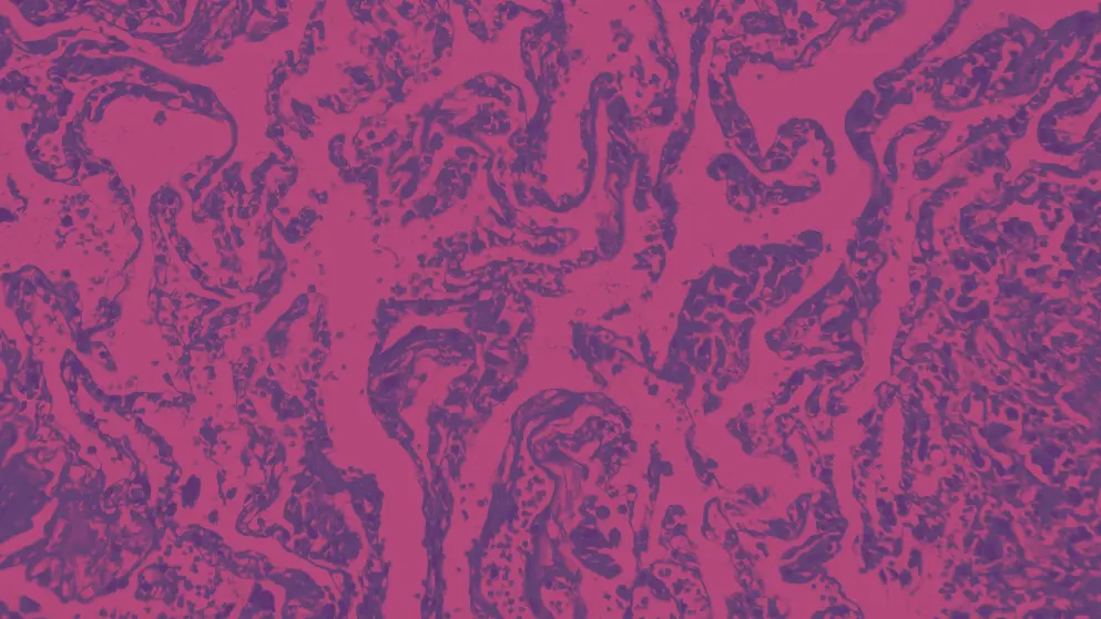 Smoker's lung, light micrograph, pink overlay