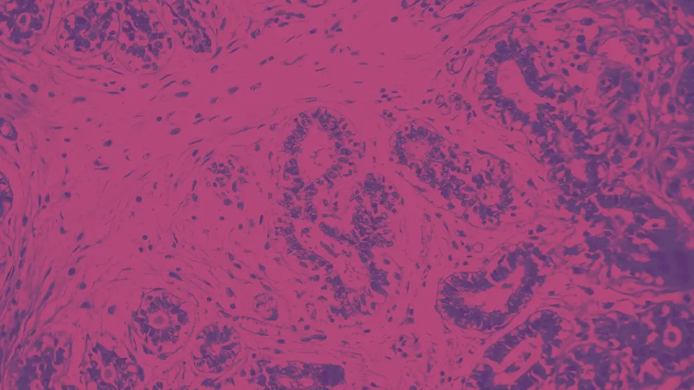 Hard breast cancer light micrograph, pink and purple colors