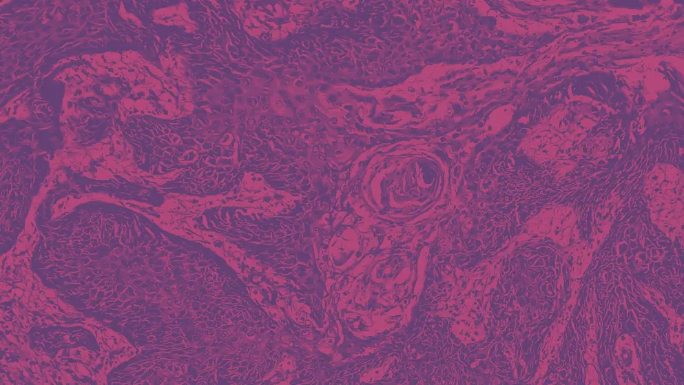 invasive squamous cell carcinoma, Skin cancer micrograph, pink and purple colors