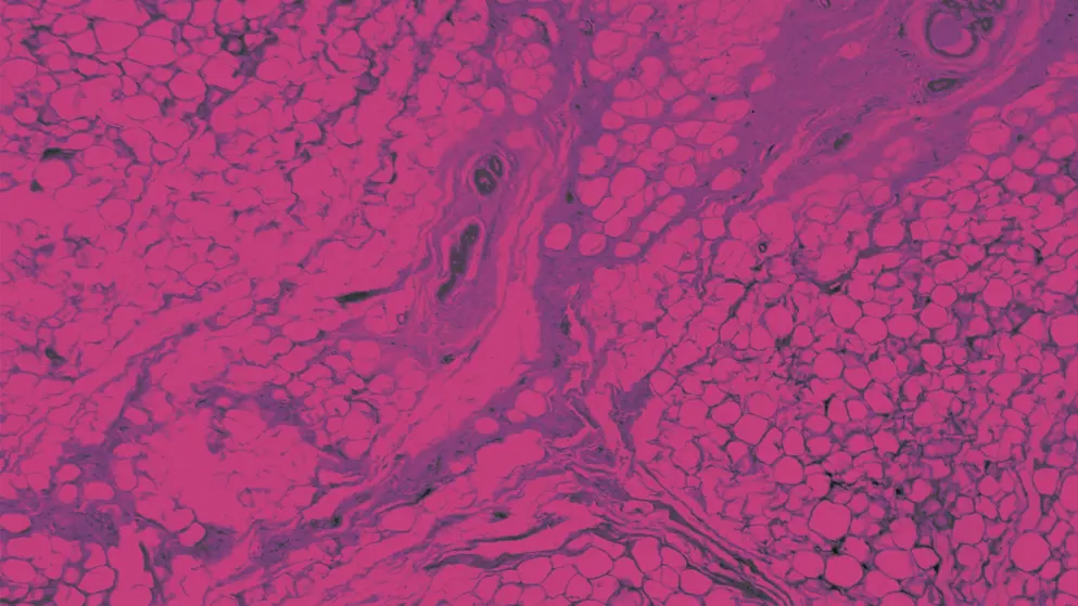 Human mammary gland cells under the microscope, pink overlay
