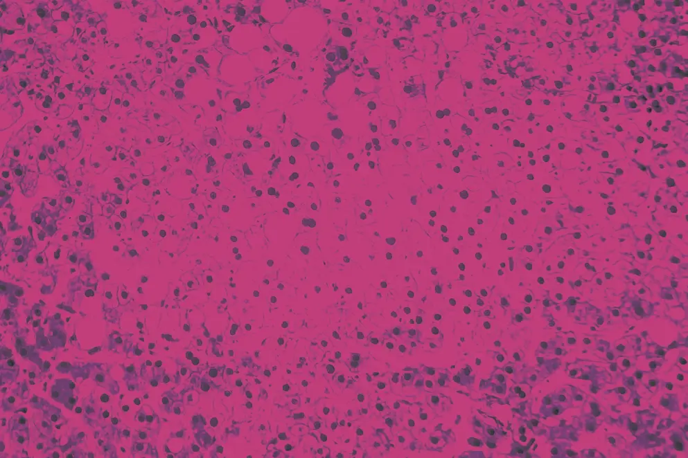 Histopathology of liver steatosis, or fatty liver. Light micrograph, photo under microscope