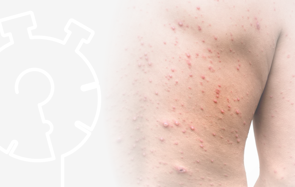 Herpes Quiz Hero