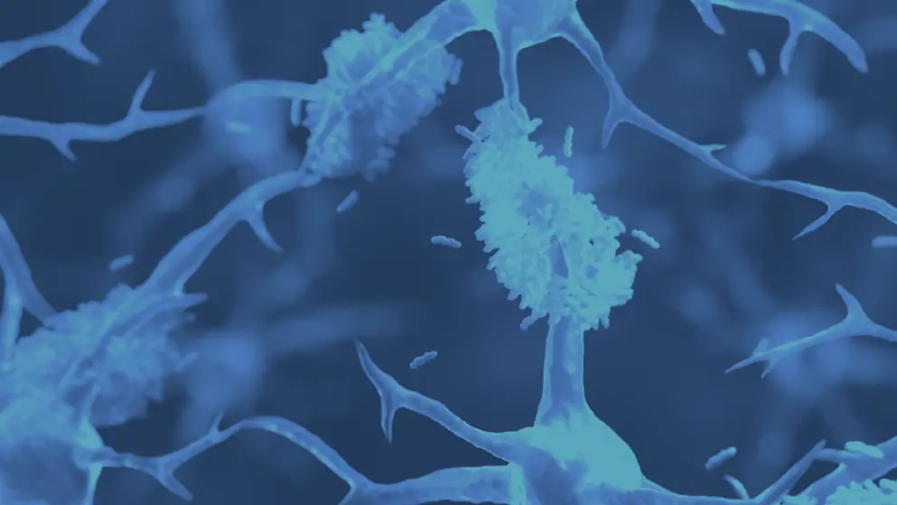 Amyloid plaque forming between neurons in Alzheimer disease, cell image, blue overlay