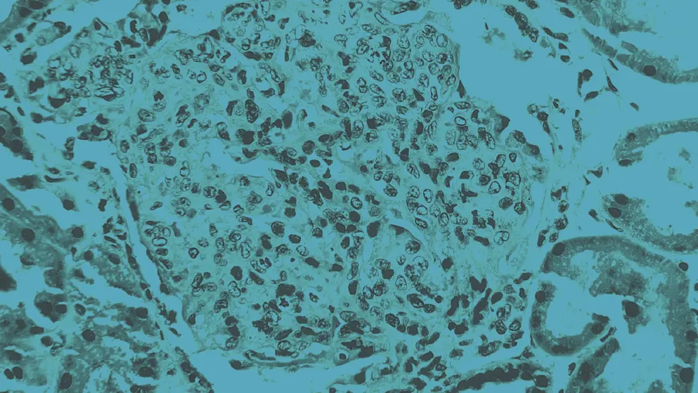 endocapillary hypercellularity in lupus nephritis, cellular image, blue overlay
