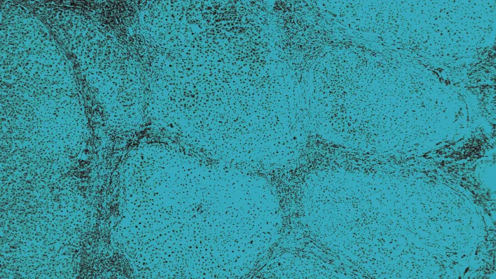 Liver Cirrhosis, cellular image, blue overlay