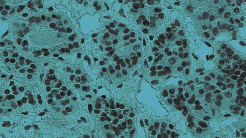 pituitary adenoma, cellular image, blue overlay