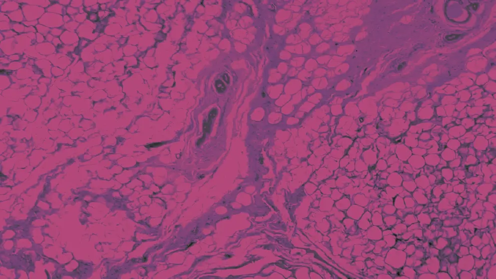 Human mammary gland cells under the microscope_pink and purple colours