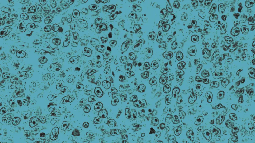 diffuse large Bcell lymphoma, cellular image, blue overlay