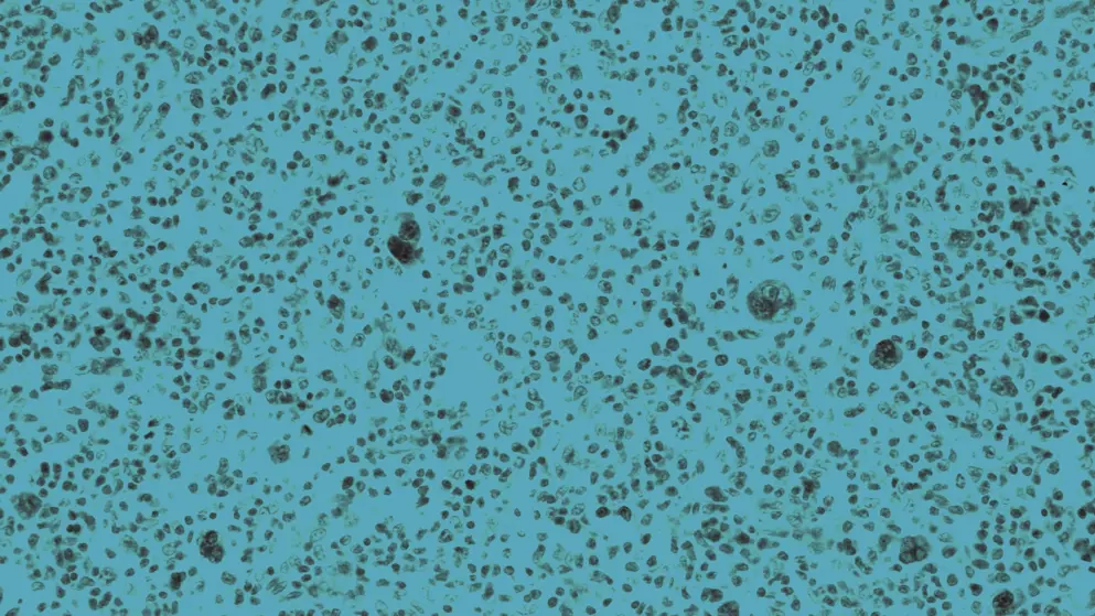 Lymph node_Hodgkin lymphoma, cellular image, blue overlay