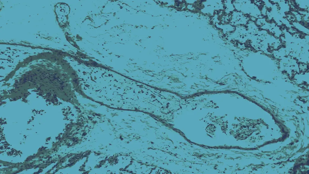 Transparent thrombosis, light micrograph, cellular image, blue overlay