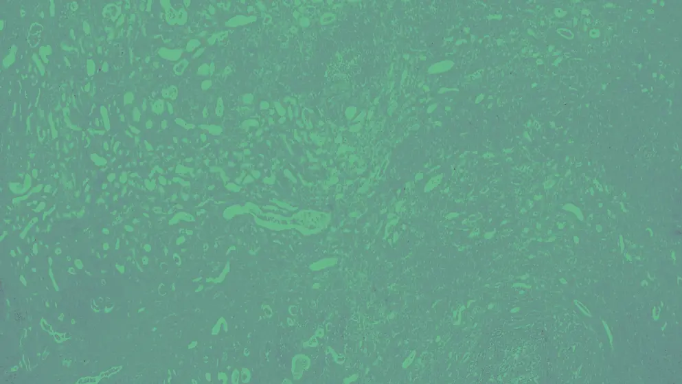 Tuberculosis in the lungs, rendered in green