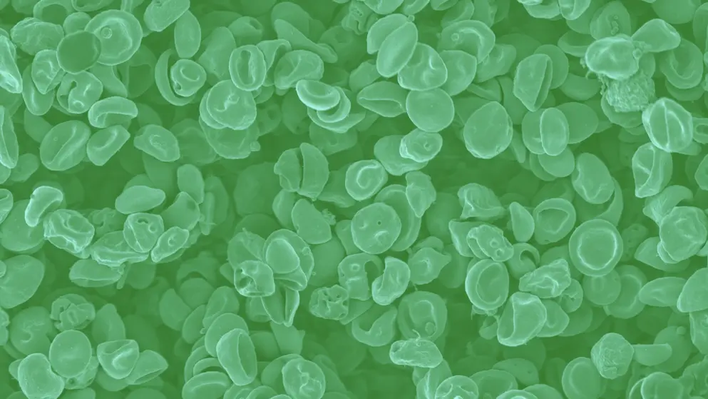Dysmorphic blood cells, cell image, green overlay