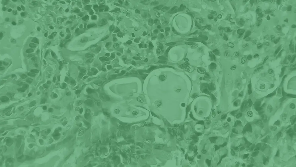 Lung cancer, cell image, green overlay