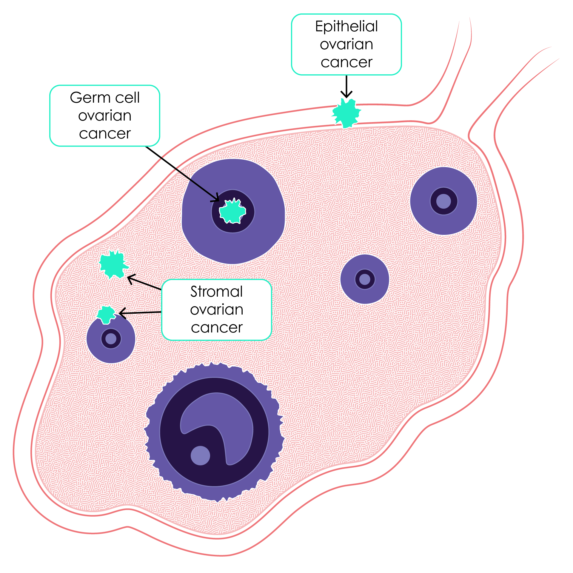 Ovarian cancer types