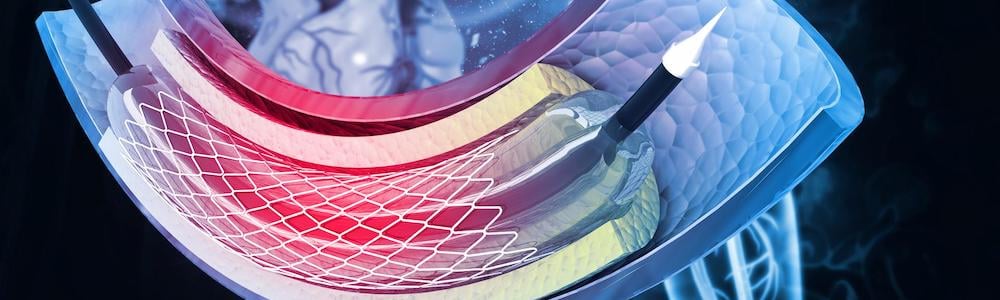 Balloon angioplasty procedure with stent in vein