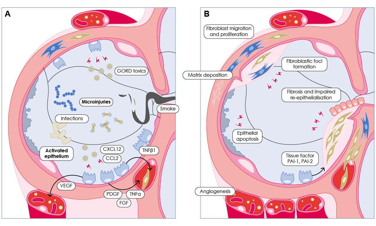 Schematic view of IPF pathogenesis