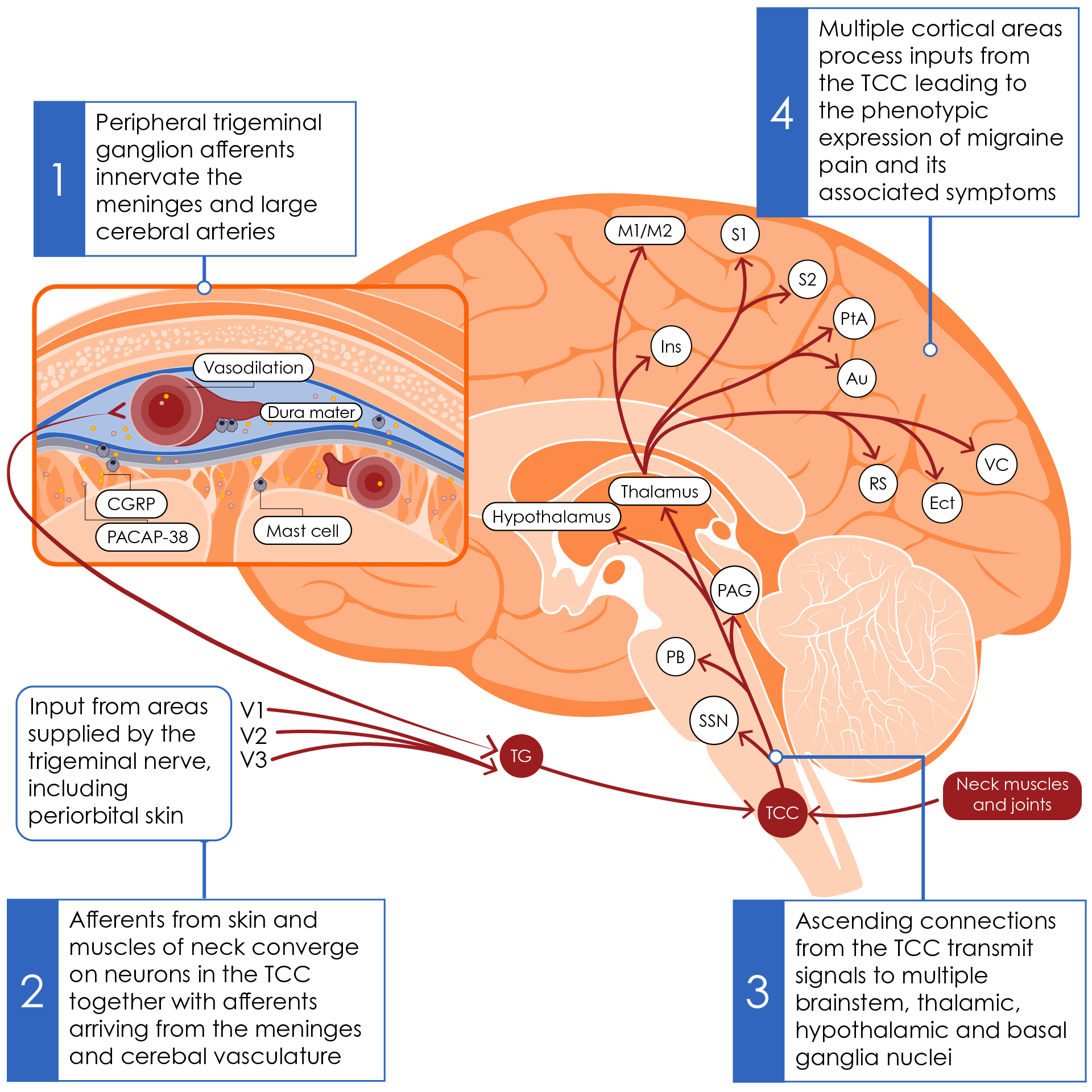 Production of migraine pain through the trigeminovascular pathway