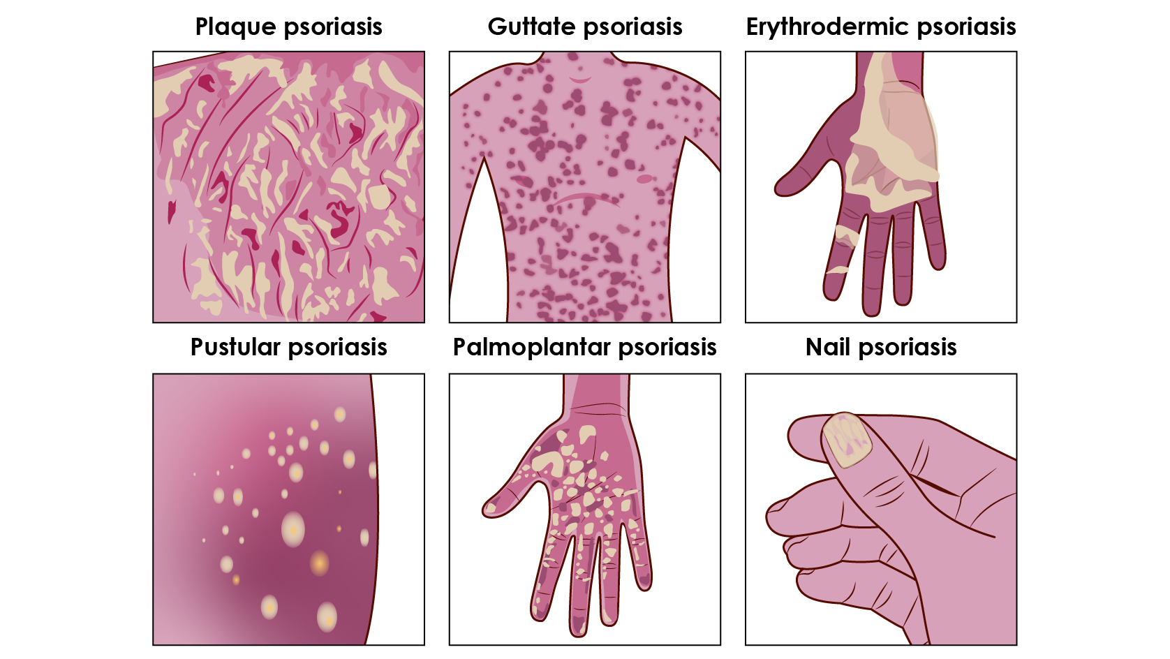 There are several main types of psoriasis, each presenting with different symptoms and characteristics.