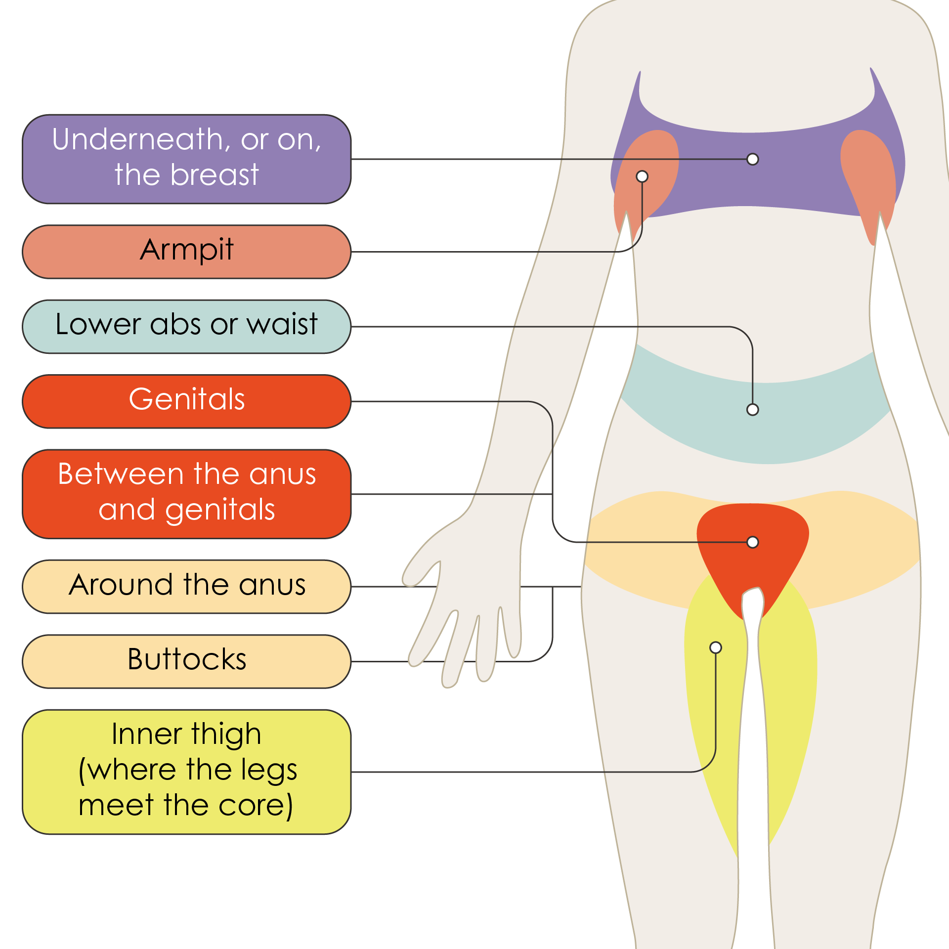 A colour-coded diagram illustrating common areas of skin in which hidradenitis suppurativa can develop. These commonly affected areas are located on the upper body (on or underneath the breasts, the lower abdominal region, and waist) as well as on the lower body (inner thighs, buttocks) and genital areas.