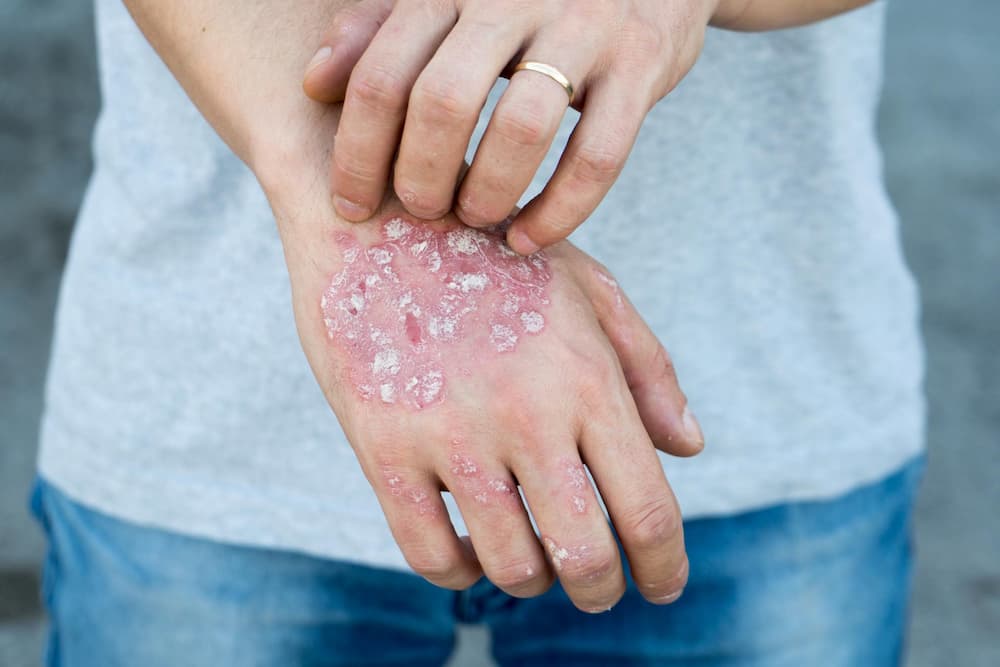 Plaque Psoriasis