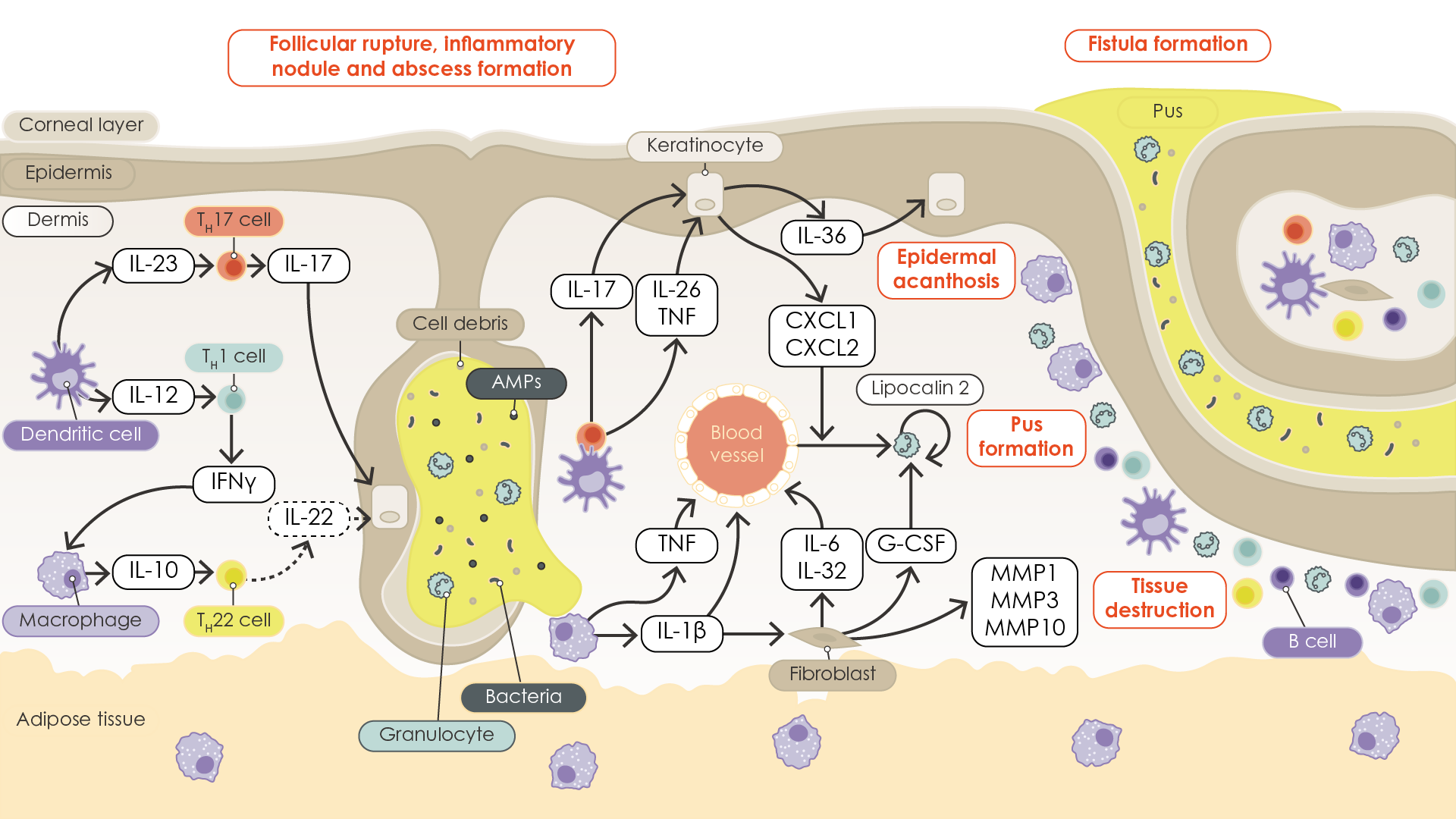 Diagram displaying a cross-section of skin and the inflammatory pathways involved in the progression of hidradenitis suppurativa to advanced disease. Follicular rupture, inflammatory nodule and abscess formation, as well as fistula formation, are illustrated alongside the various cells involved in these processes.
