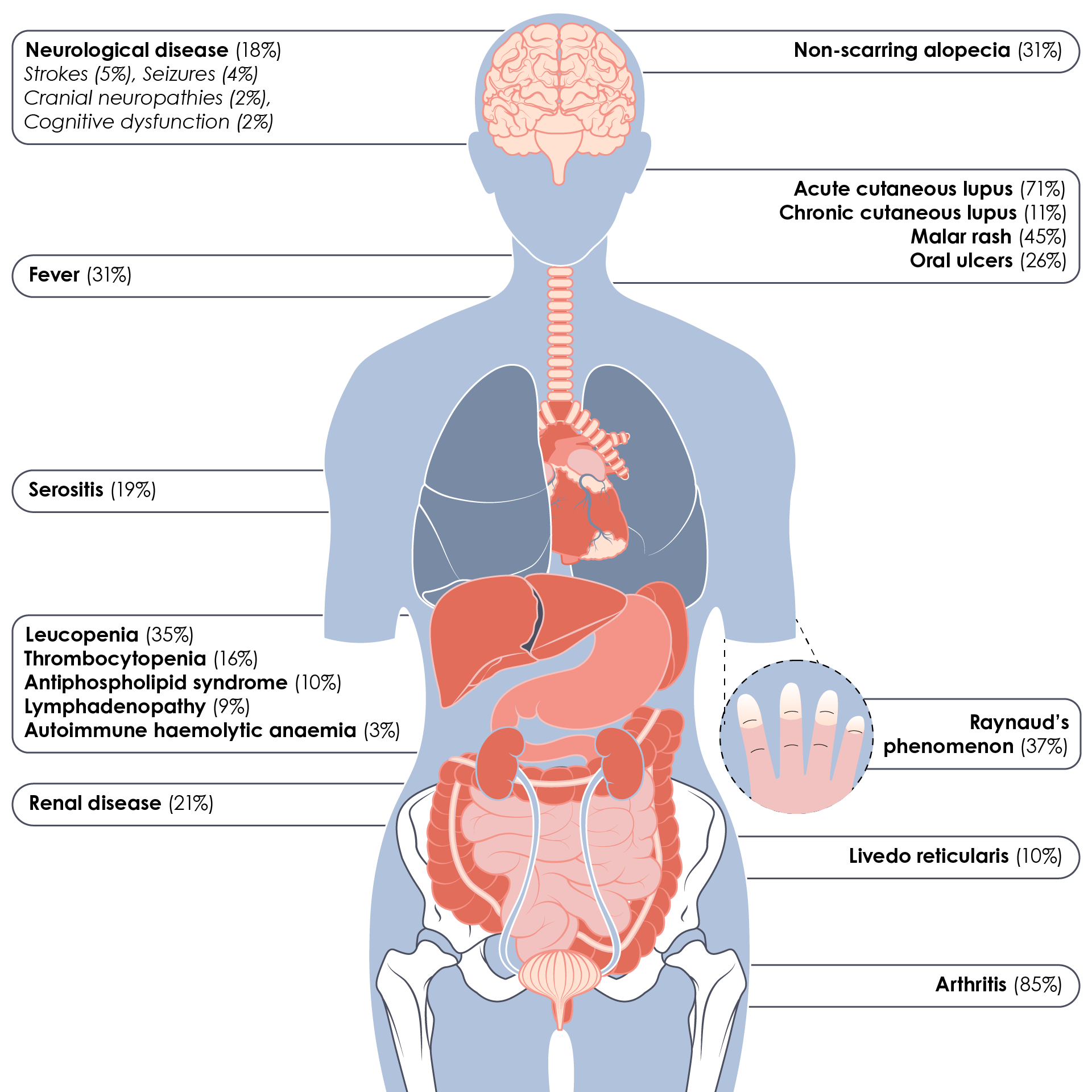 Summary of the signs and symptoms of SLE showing cumulative frequencies for each