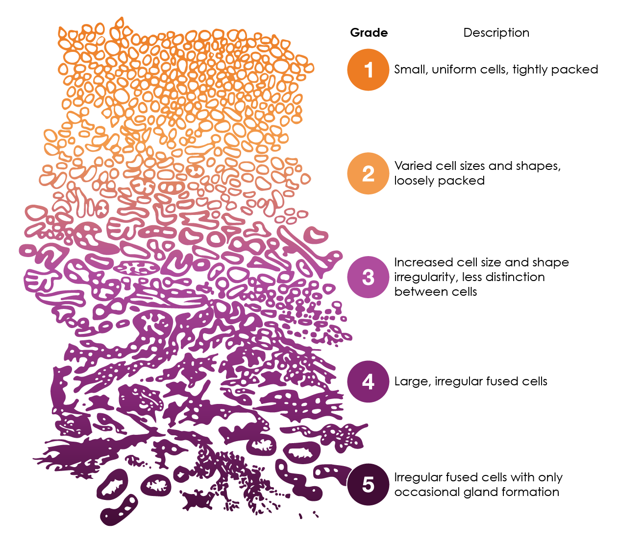 Figure 8. Gleason patterns and associated grades for glandular structures of the prostate. Adapted from NCI SEER training module