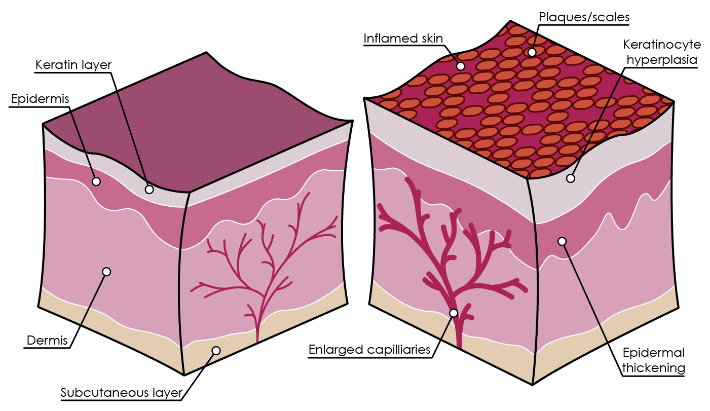 Figure 3. Psoriasis pathophysiology (adapted from Palfreeman et al., 2013).