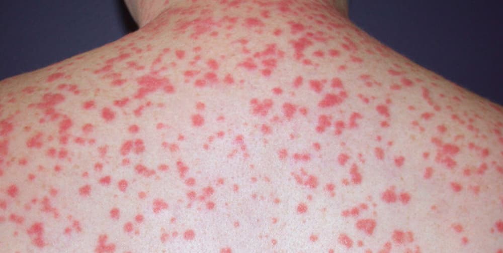 Guttate psoriasis (National Psoriasis Foundation, 2019.