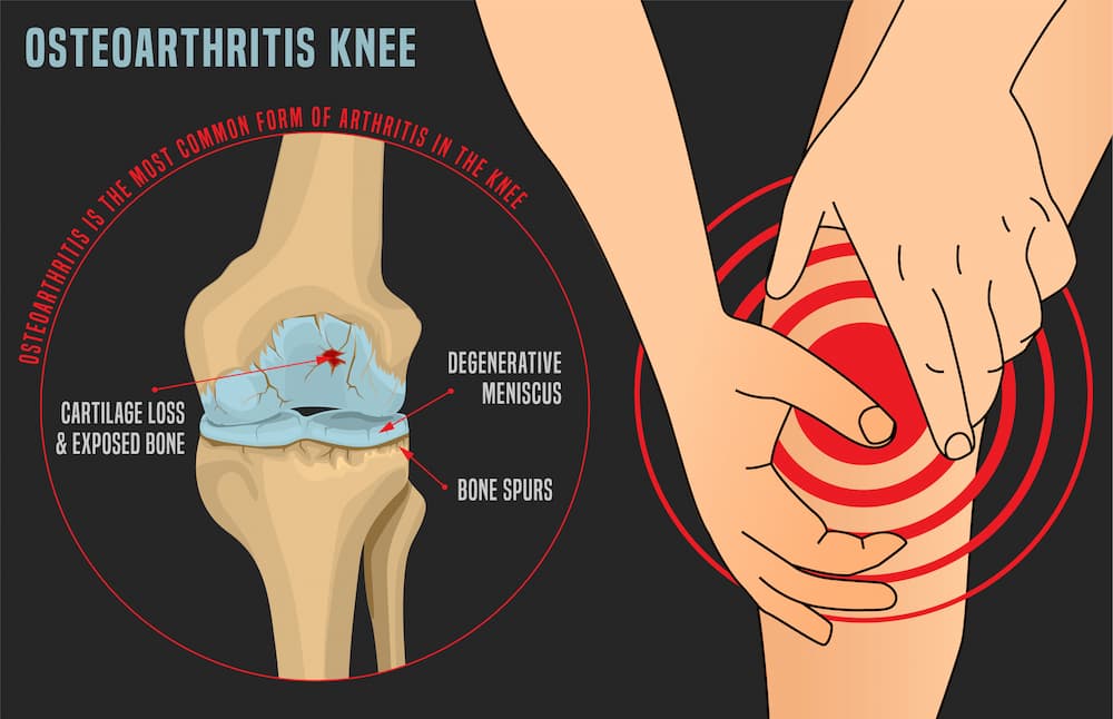 Pain associated with OA is significant and requires an alternative management approach