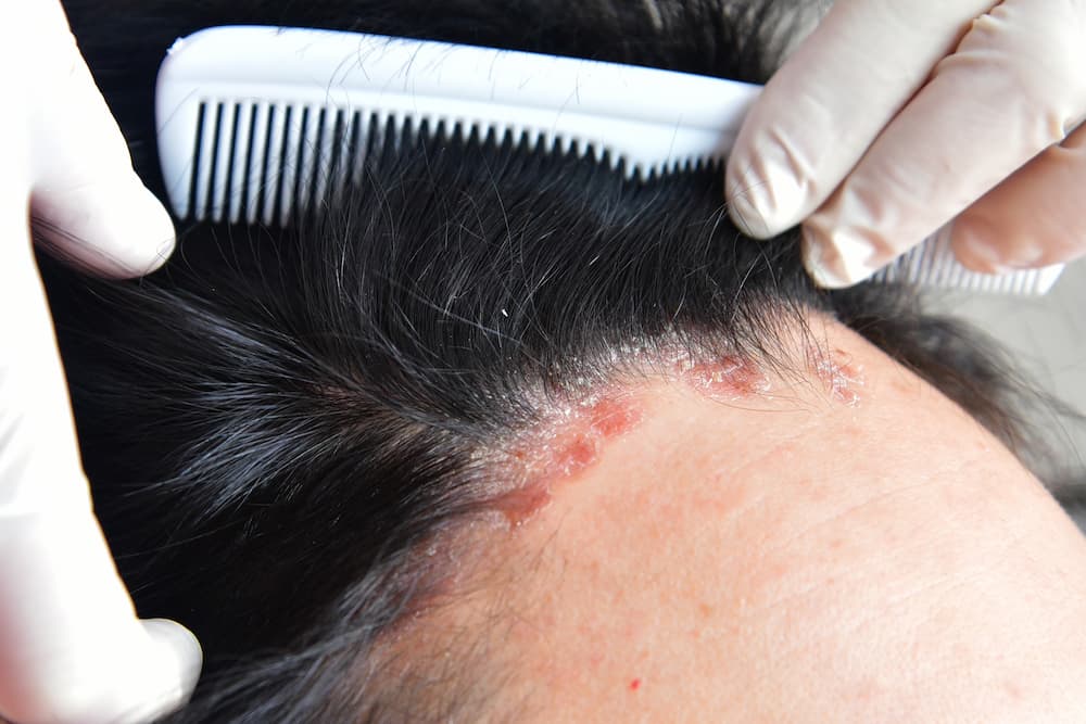 Scalp psoriasis and teledermatology