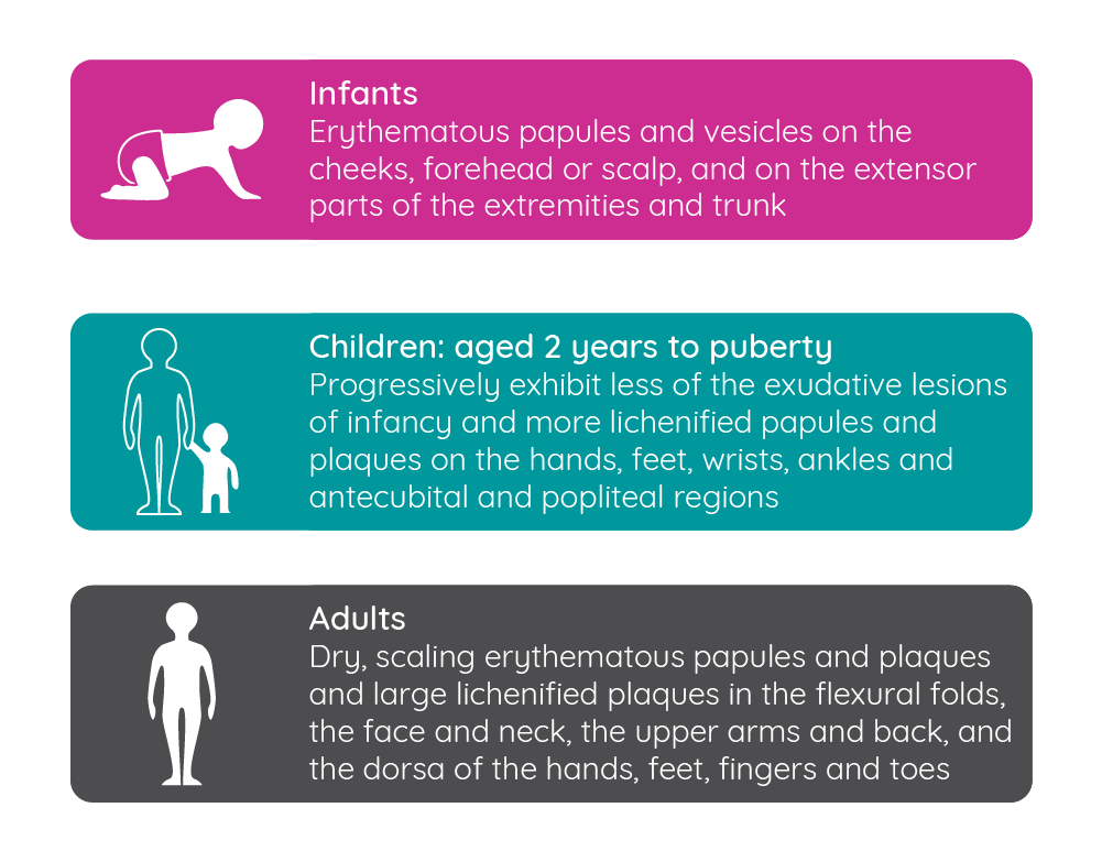 Changes in the clinical presentation of atopic dermatitis over time