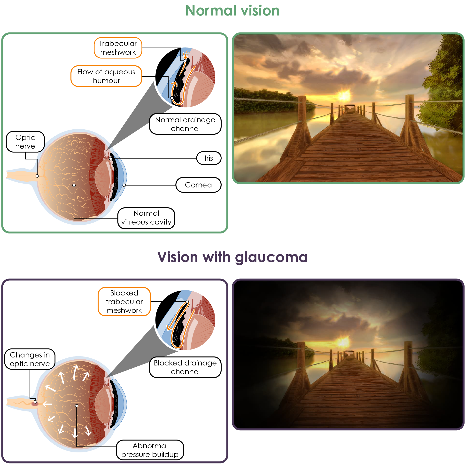 Open angle glaucoma and depiction of vision in normal versus glaucomatous vision