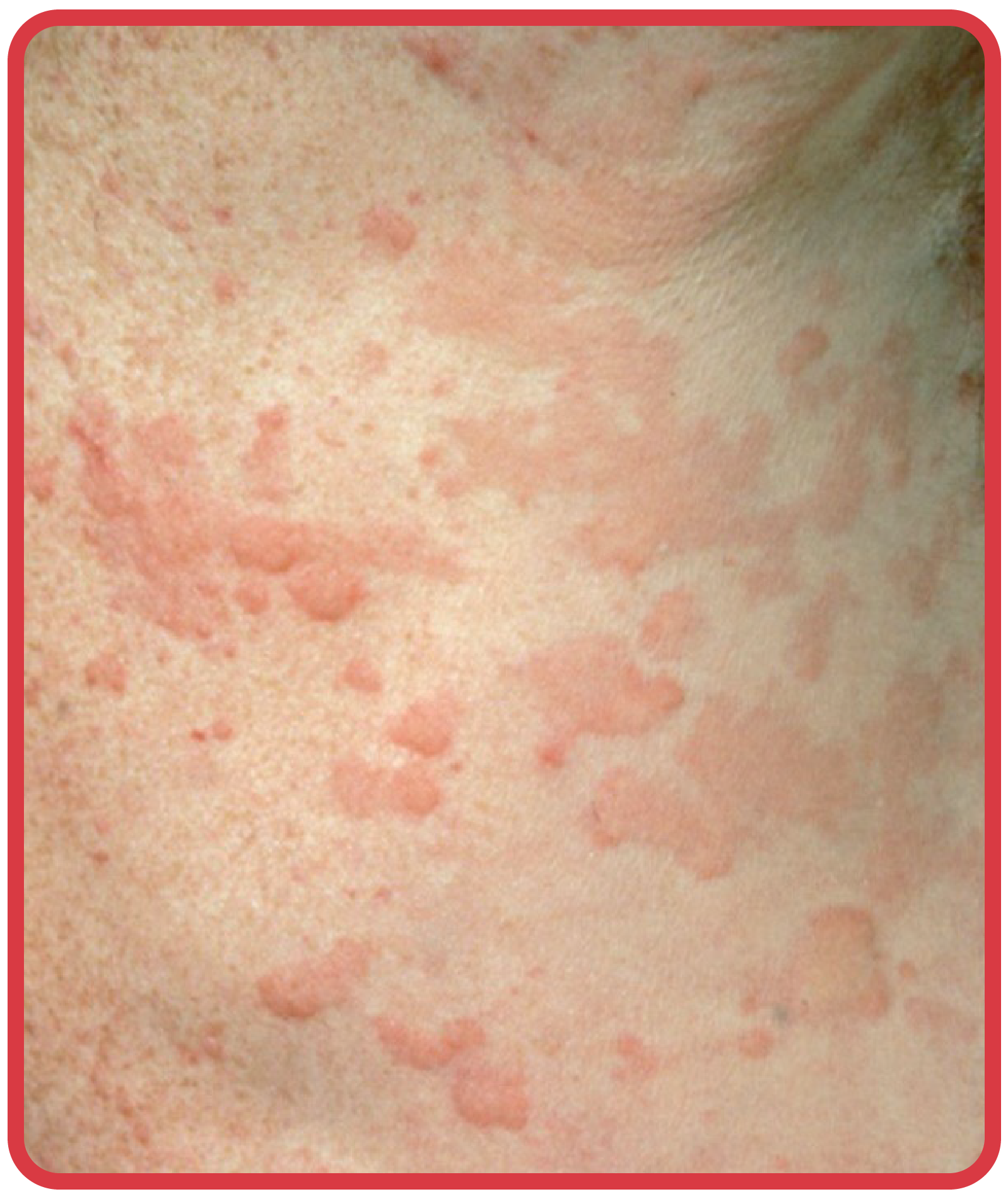 Image showing multiple pale-centered, red-edged hives on the upper chest area. The swellings vary in size and are merging in places.